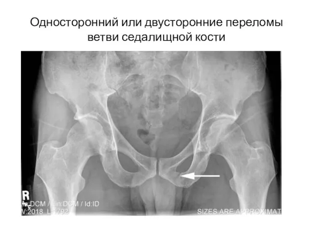 Односторонний или двусторонние переломы ветви седалищной кости