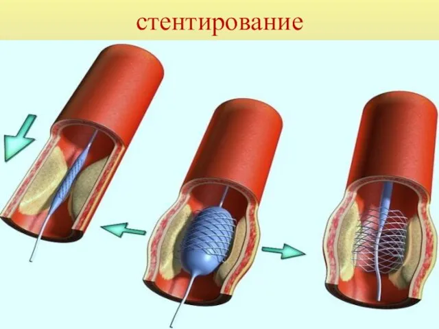 стентирование