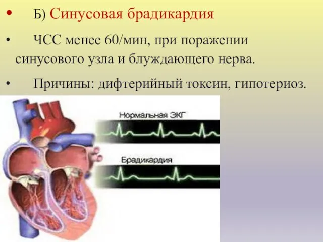 Б) Синусовая брадикардия ЧСС менее 60/мин, при поражении синусового узла и