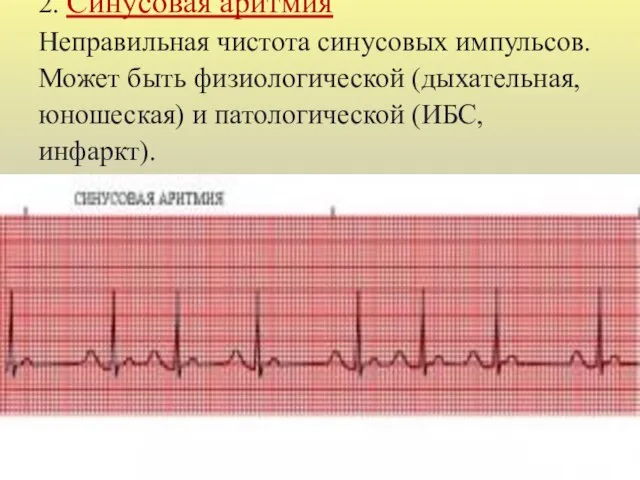 2. Синусовая аритмия Неправильная чистота синусовых импульсов. Может быть физиологической (дыхательная, юношеская) и патологической (ИБС, инфаркт).