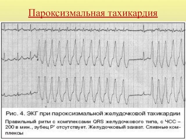 Пароксизмальная тахикардия