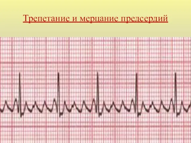 Трепетание и мерцание предсердий