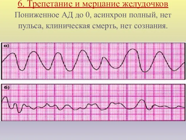 6. Трепетание и мерцание желудочков Пониженное АД до 0, асинхрон полный,