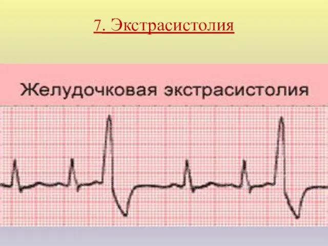 7. Экстрасистолия