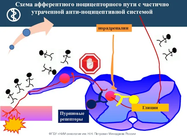 Схема афферентного ноцицепторного пути с частично утраченной анти-ноцицептивной системой норадреналин Глицин Пуриновые рецепторы