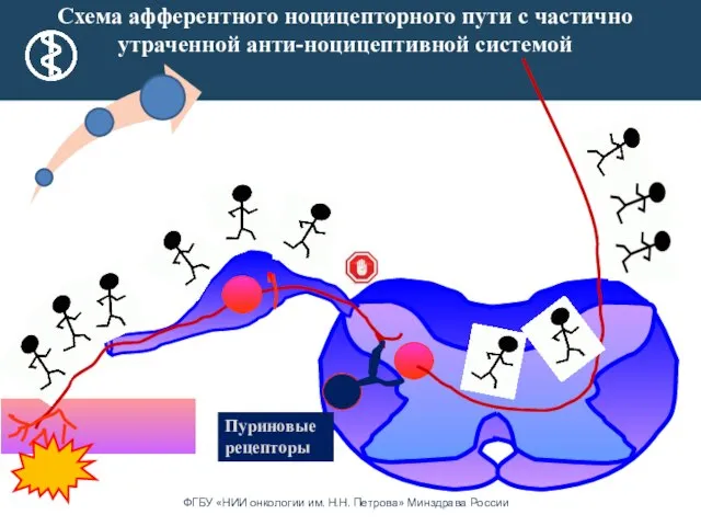 Схема афферентного ноцицепторного пути с частично утраченной анти-ноцицептивной системой Пуриновые рецепторы