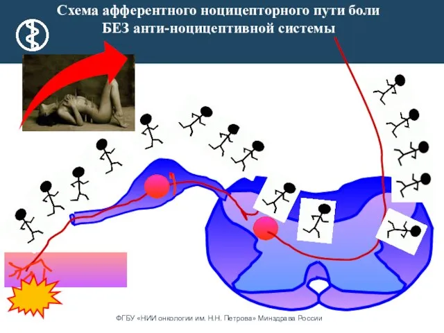 Схема афферентного ноцицепторного пути боли БЕЗ анти-ноцицептивной системы