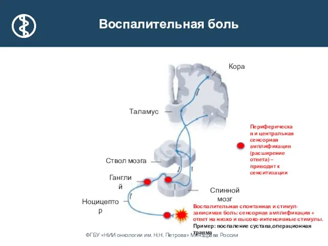 Таламус Ганглий Ствол мозга Кора Ноцицептор Спинной мозг Воспалительная боль Воспалительная