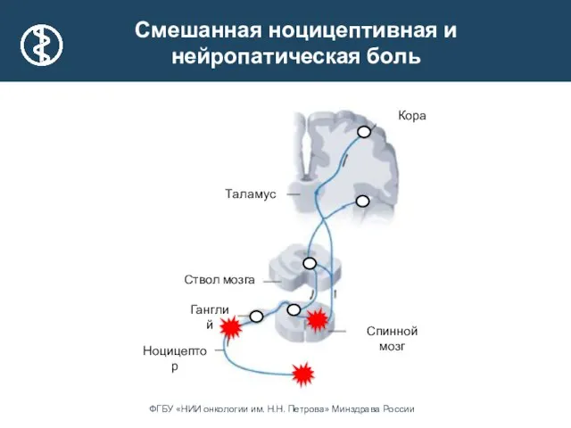 Таламус Ганглий Ствол мозга Кора Ноцицептор Спинной мозг Смешанная ноцицептивная и нейропатическая боль