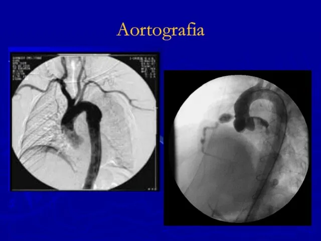 Aortografia