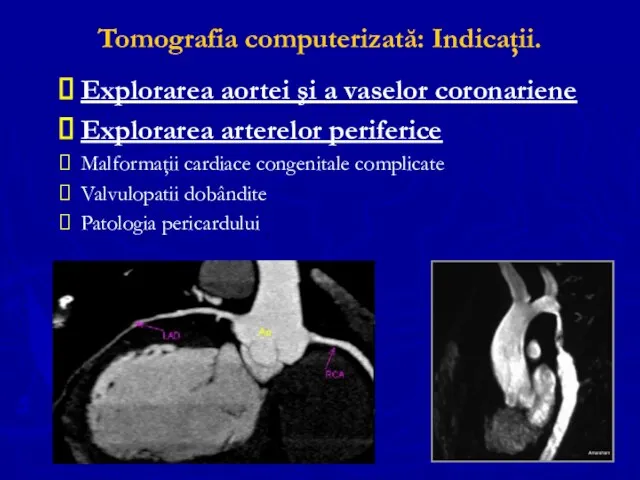Tomografia computerizată: Indicaţii. Explorarea aortei şi a vaselor coronariene Explorarea arterelor
