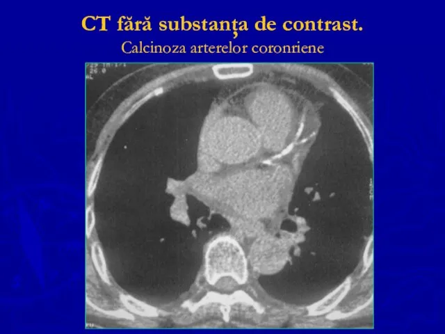 CT fără substanţa de contrast. Calcinoza arterelor coronriene