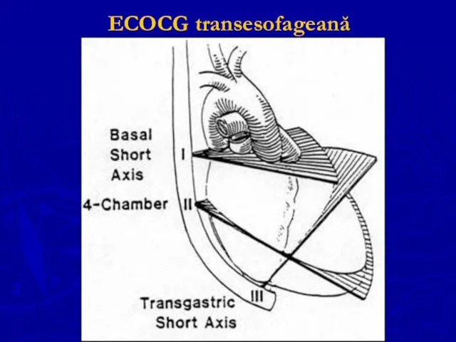 ECOCG transesofageană