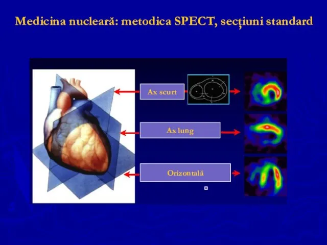 Medicina nucleară: metodica SPECT, secţiuni standard Ax scurt Ax lung Orizontală