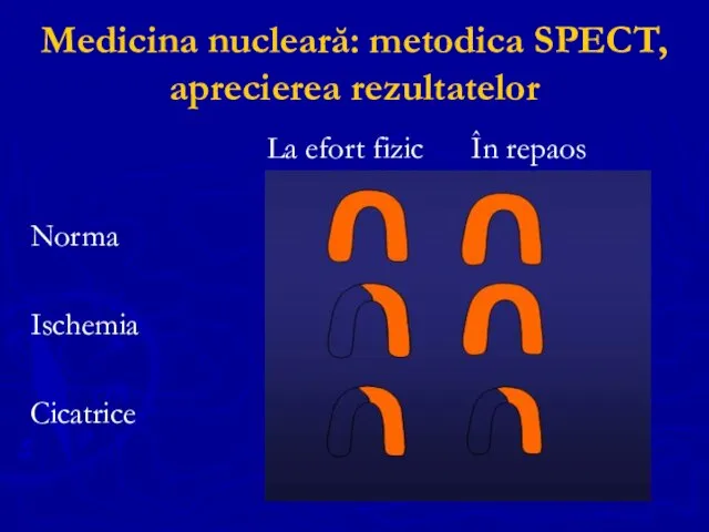 Medicina nucleară: metodica SPECT, aprecierea rezultatelor La efort fizic În repaos Norma Ischemia Cicatrice