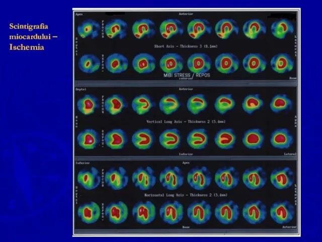 Scintigrafia miocardului – Ischemia
