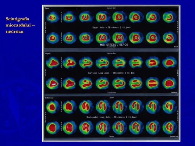 Scintigrafia miocardului – necroza