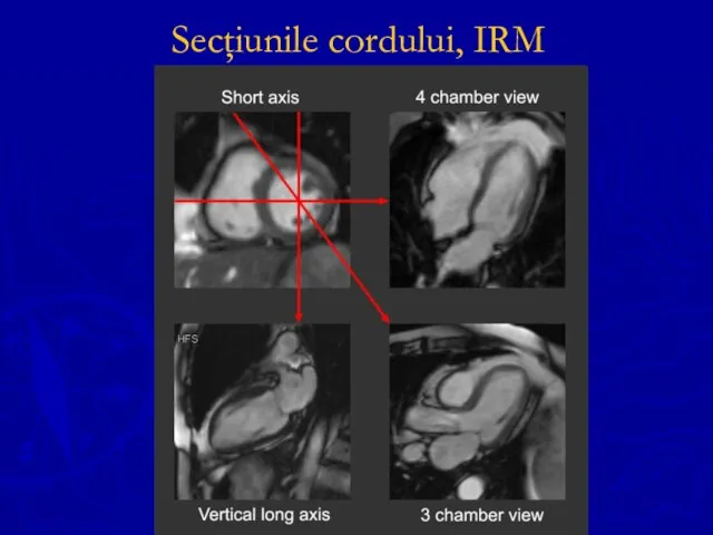 Secţiunile cordului, IRM