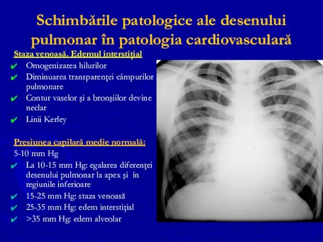 Schimbările patologice ale desenului pulmonar în patologia cardiovasculară Staza venoasă. Edemul
