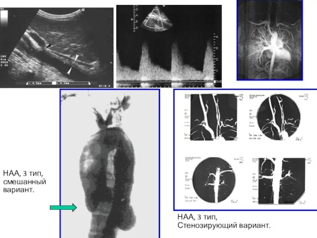 НАА, 3 тип, Стенозирующий вариант. НАА, 3 тип, смешанный вариант.