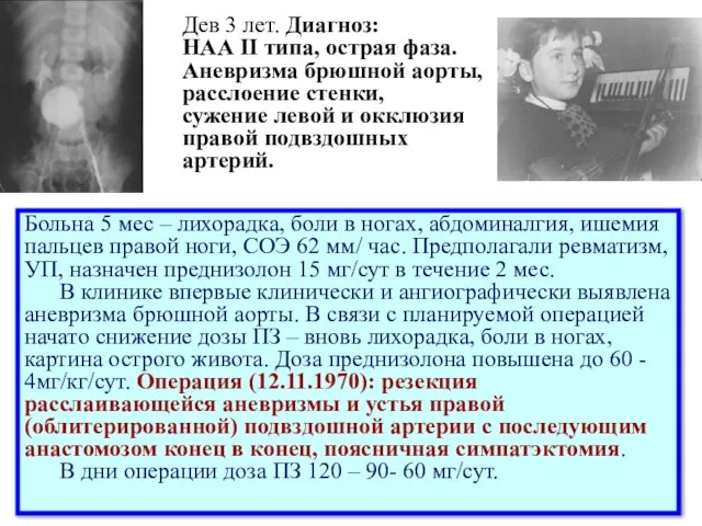 Больна 5 мес – лихорадка, боли в ногах, абдоминалгия, ишемия пальцев