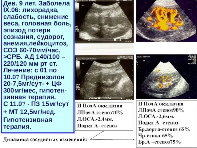 Дев. 9 лет. Заболела IX.06: лихорадка, слабость, снижение веса, головная боль,