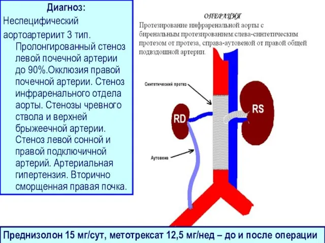 Диагноз: Неспецифический аортоартериит 3 тип. Пролонгированный стеноз левой почечной артерии до