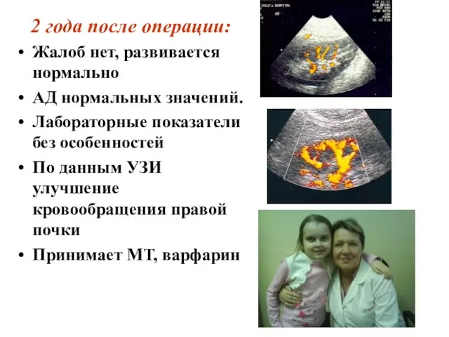 2 года после операции: Жалоб нет, развивается нормально АД нормальных значений.