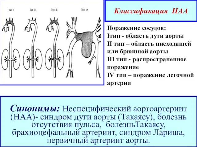 Синонимы: Неспецифический аортоартериит (НАА)- синдром дуги аорты (Такаясу), болезнь отсутствия пульса,