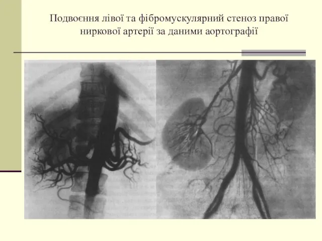 Подвоєння лівої та фібромускулярний стеноз правої ниркової артерії за даними аортографії