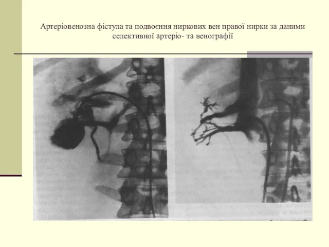 Артеріовенозна фістула та подвоєння ниркових вен правої нирки за даними селективної артеріо- та венографії