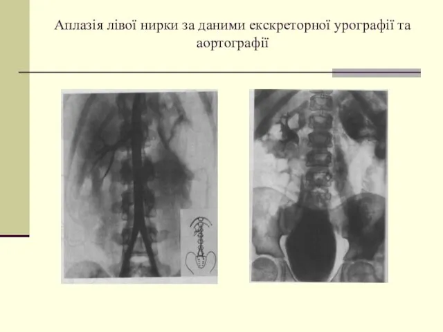 Аплазія лівої нирки за даними екскреторної урографії та аортографії