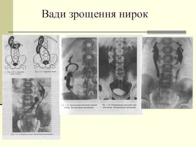 Вади зрощення нирок