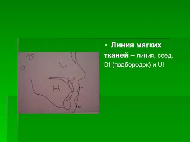Линия мягких тканей – линия, соед. Dt (подбородок) и UI