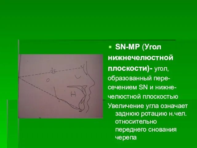 SN-MP (Угол нижнечелюстной плоскости)- угол, образованный пере- сечением SN и нижне-