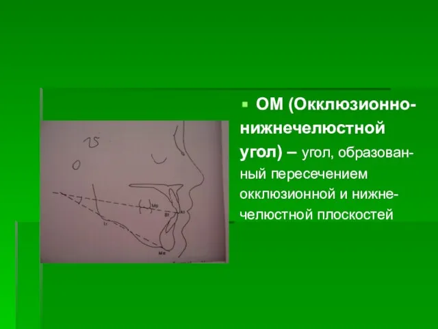 OM (Окклюзионно- нижнечелюстной угол) – угол, образован- ный пересечением окклюзионной и нижне- челюстной плоскостей