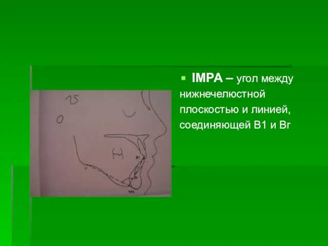 IMPA – угол между нижнечелюстной плоскостью и линией, соединяющей В1 и Вr