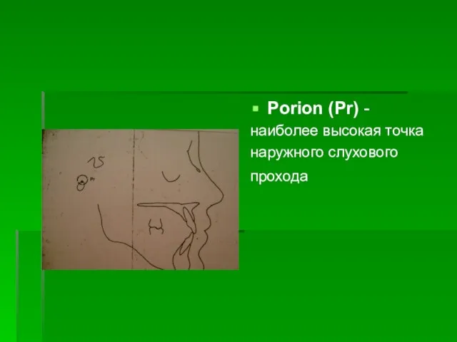 Porion (Pr) - наиболее высокая точка наружного слухового прохода