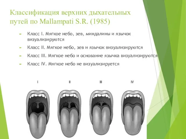 Классификация верхних дыхательных путей по Mallampati S.R. (1985) Класс I. Мягкое