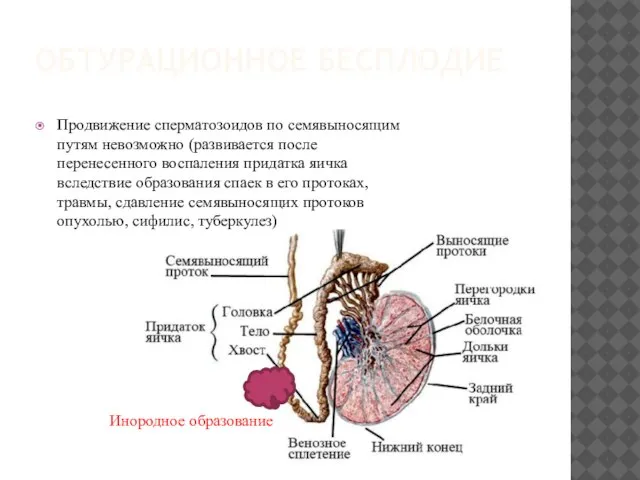 ОБТУРАЦИОННОЕ БЕСПЛОДИЕ Продвижение сперматозоидов по семявыносящим путям невозможно (развивается после перенесенного