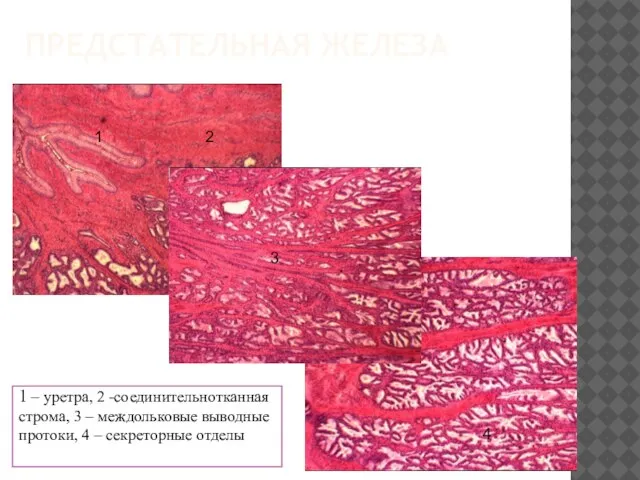 ПРЕДСТАТЕЛЬНАЯ ЖЕЛЕЗА 1 – уретра, 2 -соединительнотканная строма, 3 – междольковые