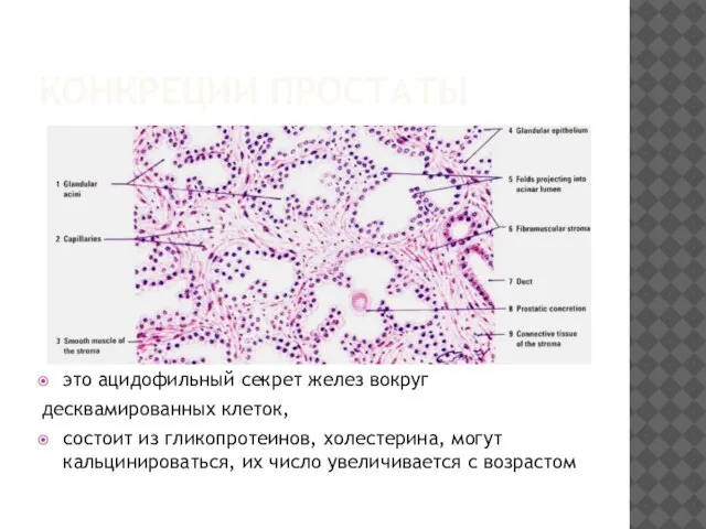 КОНКРЕЦИИ ПРОСТАТЫ это ацидофильный секрет желез вокруг десквамированных клеток, состоит из