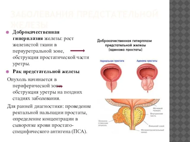 ЗАБОЛЕВАНИЯ ПРЕДСТАТЕЛЬНОЙ ЖЕЛЕЗЫ Доброкачественная гиперплазия железы: рост железистой ткани в периуретральной