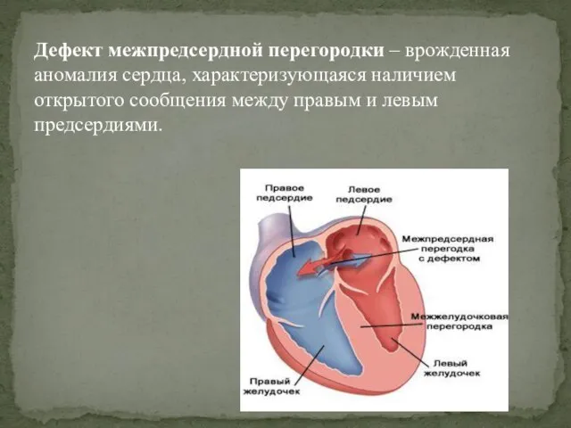 Дефект межпредсердной перегородки – врожденная аномалия сердца, характеризующаяся наличием открытого сообщения между правым и левым предсердиями.