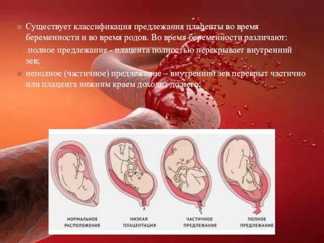 Существует классификация предлежания плаценты во время беременности и во время родов.