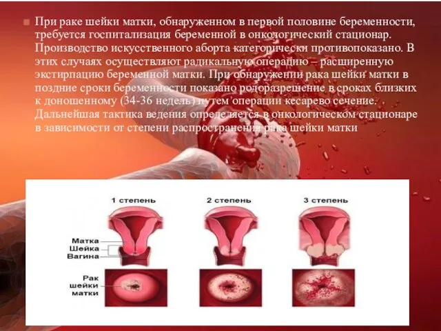 При раке шейки матки, обнаруженном в первой половине беременности, требуется госпитализация
