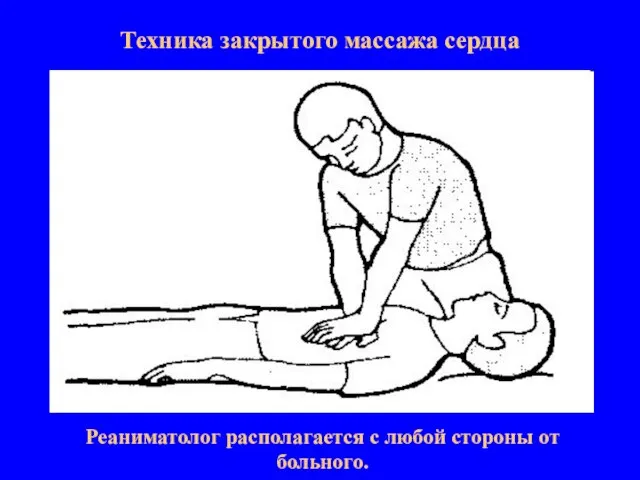 Техника закрытого массажа сердца Реаниматолог располагается с любой стороны от больного.