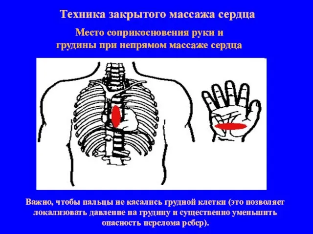 Техника закрытого массажа сердца Место соприкосновения руки и грудины при непрямом