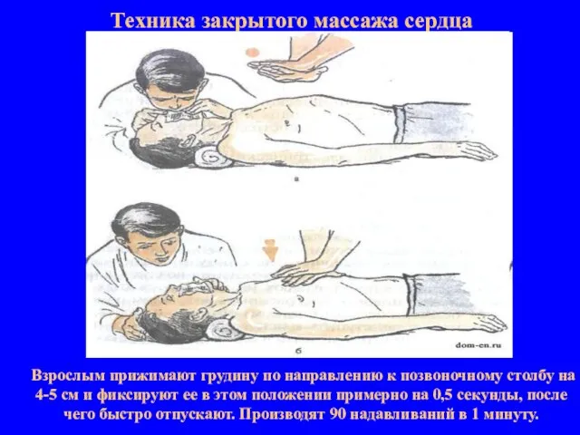 Техника закрытого массажа сердца Взрослым прижимают грудину по направлению к позвоночному