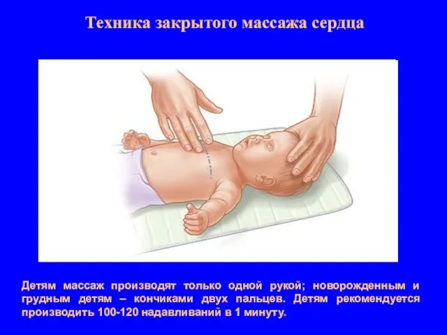Техника закрытого массажа сердца Детям массаж производят только одной рукой; новорожденным